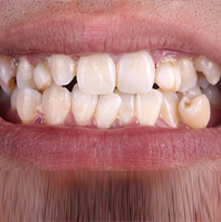 Crowded, Spaced or Crooked Teeth