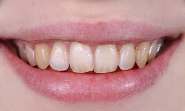 Thirroul Dental Studio Dentist North Wollongong Dentist 010102 Cosmetic Solutions Discoloured Teeth