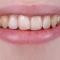 Thirroul Dental Studio Dentist North Wollongong Dentist 010102 Cosmetic Solutions Discoloured Teeth Thumb