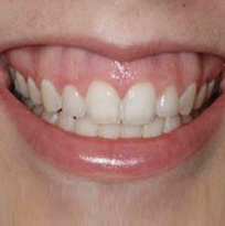Thirroul Dental Studio Dentist North Wollongong Dentist 010102 Cosmetic Solutions Gummy Smile Thumb