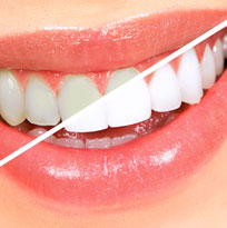 Teeth Solutions (Restorative)