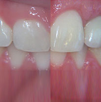 Thirroul Dental Studio Dentist North Wollongong Dentist 0103 Gum Reshaping Contouring Thumb.jpg