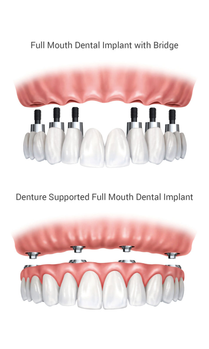 ​ © Thirroul Dental Studio Dentist North Wollongong Dentist 0303 Dental Implant