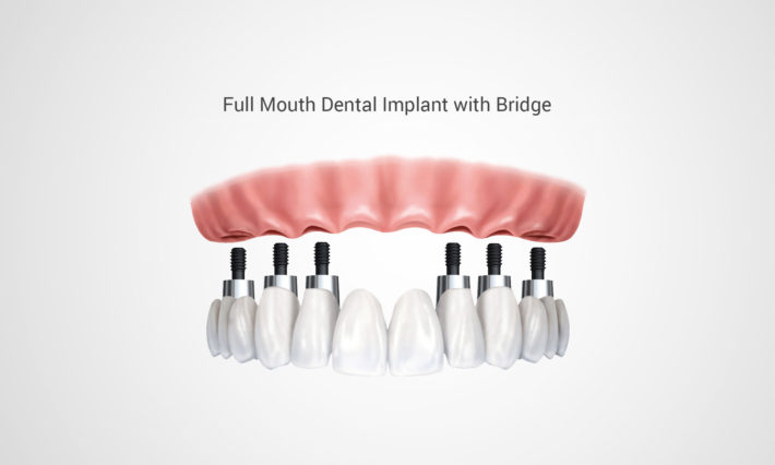 Thirroul Dental Studio Dentist North Wollongong Dentist 0303A Dental Implant