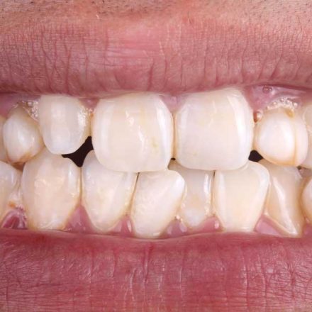 Crowded, Spaced or Crooked Teeth