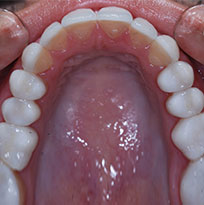 White Fillings & Mercury Removal
