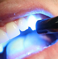 Dental Composite (Bonding)