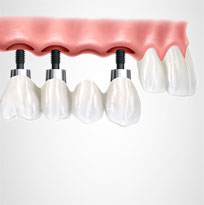 Thirroul Dental Studio Dentist North Wollongong Dentist 0303 Thumb Dental Implant (1)
